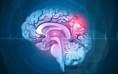 Brain Stroke Unit & Seizures